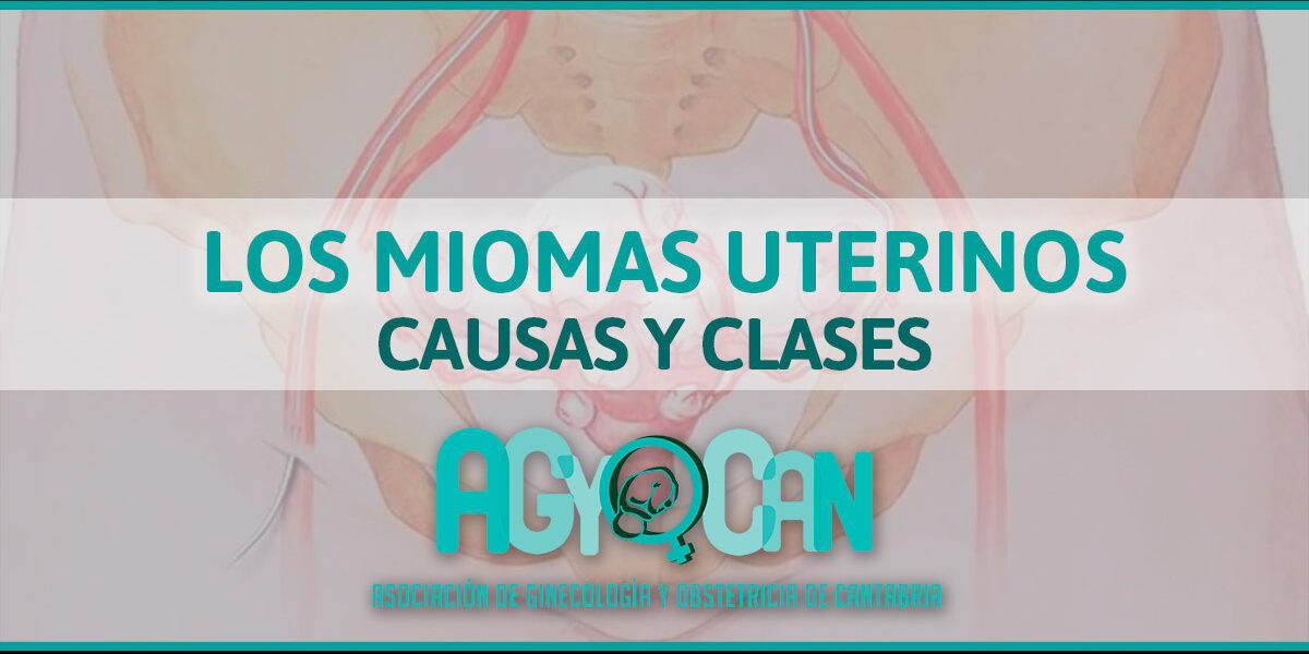 MIOMAS UTERINOS CLASES Y CAUSAS MIOMAS UTERINOS CLASES Y CAUSAS