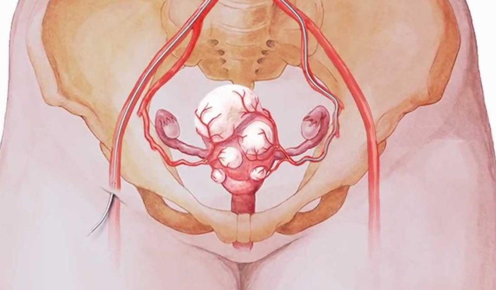 mioma uterino